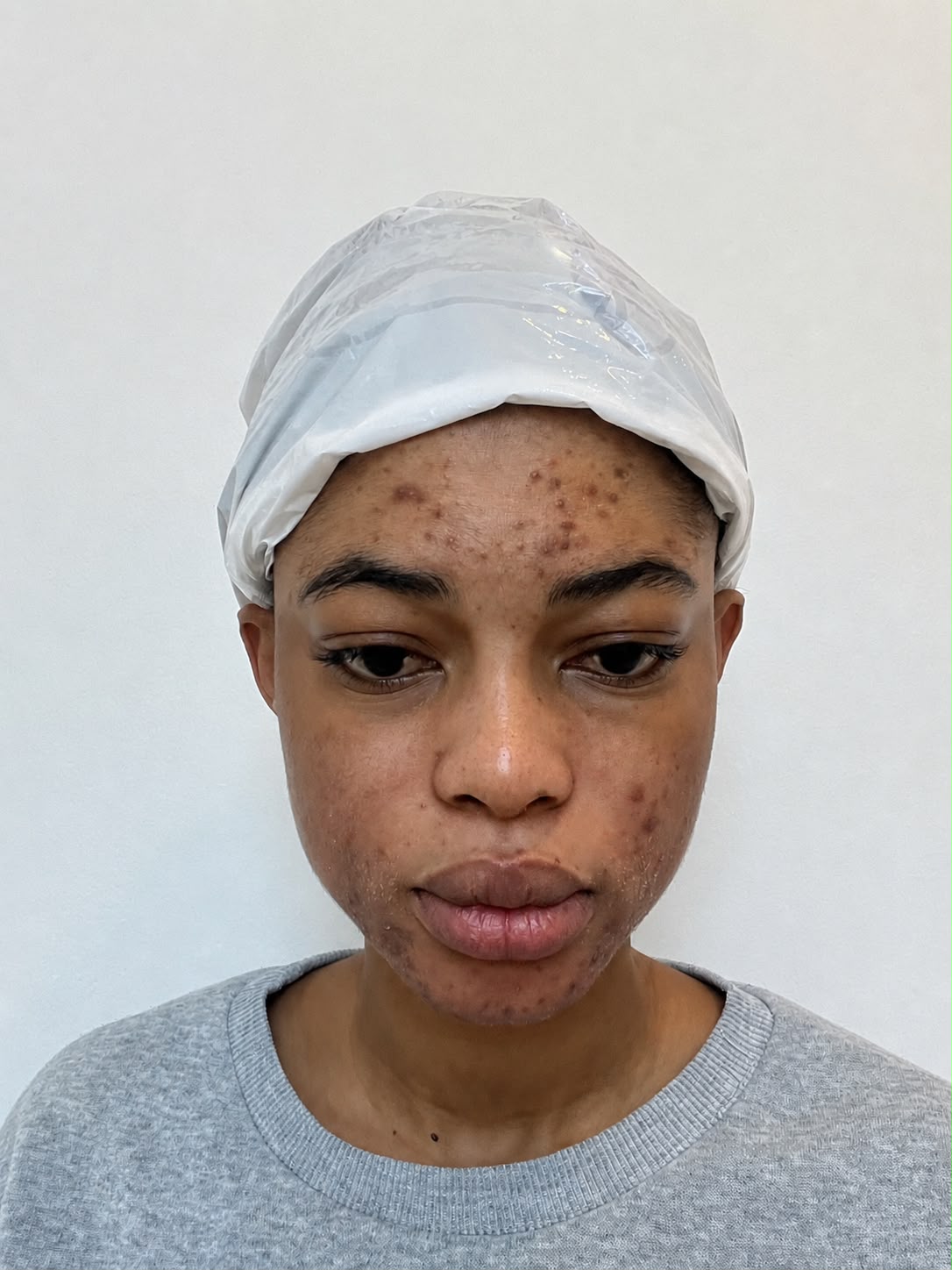 Registo partilhado por cliente do Acnes Oil Control
